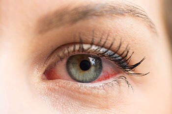 Eye affected by dry eye syndrome