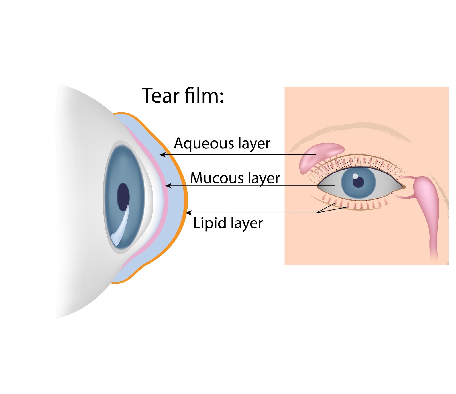Eye affected by dry eye